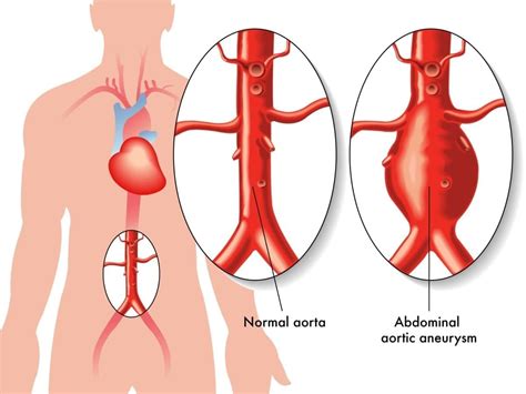 aneurisma aortico abdominal aaa familydoctororg