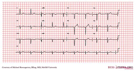 degree av block ekg examples wikidoc