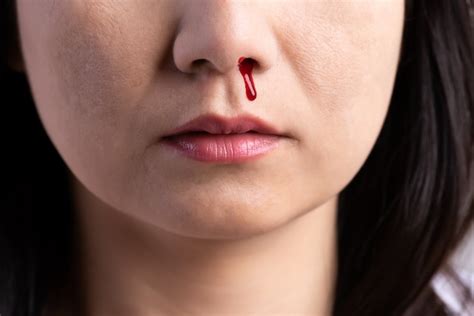premium photo nosebleed woman   bloody nose healthcare concept