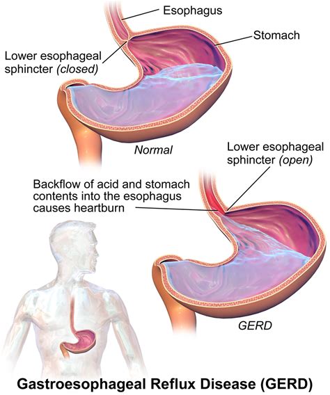 sleepyheadcentral abcs  sleep gastroesophageal reflux disease gerd