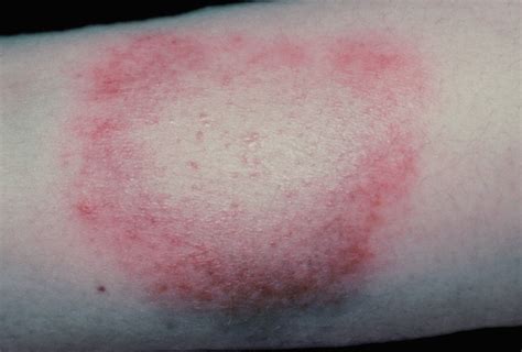 disease   catch   tick bite lyme disease symptoms