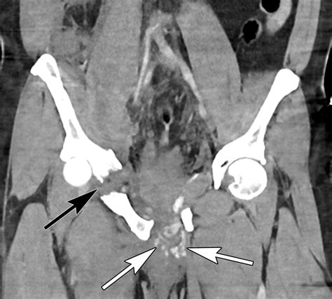 Imaging Of Acute Conditions Of The Perineum Radiographics