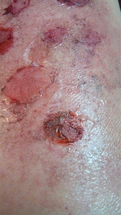 infected skin bad skin day horror amino