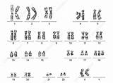 18 Karyotype Trisomy Female sketch template