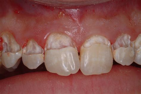 decay removed  teeth showing underlying tooth structure teeth good bad   ugly