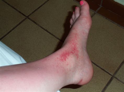 heat rash  foot pictures pictures
