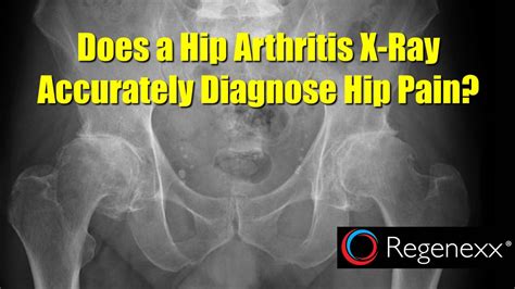 hip arthritis  ray
