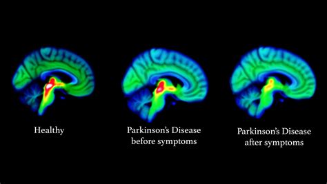 earliest signs  parkinsons disease uncovered  brain scientists