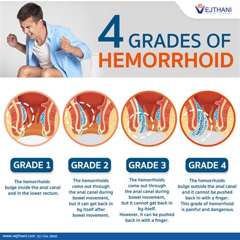 do you have hemorrhoids how severe is your hemorrhoid vejthani