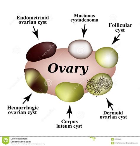 types of ovarian cysts set infographics vector illustration on
