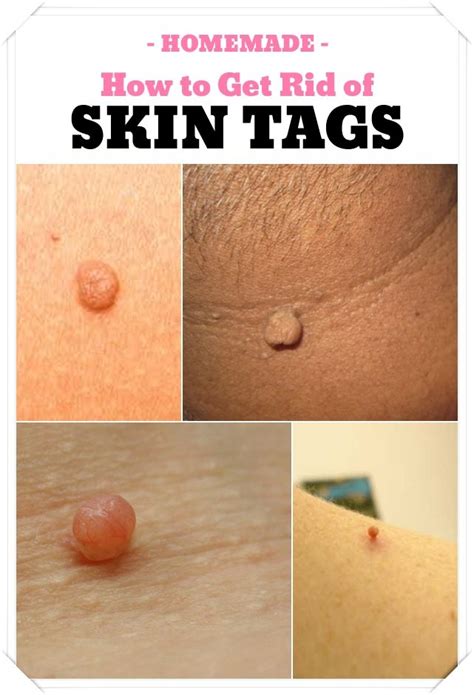 how to get rid of skin tags by skin tag