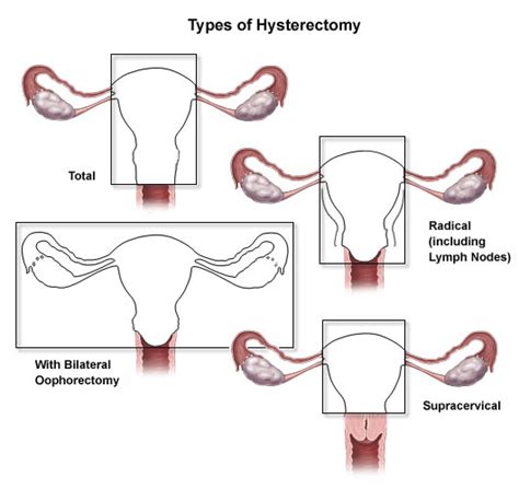 Hysterectomy Johns Hopkins Medicine
