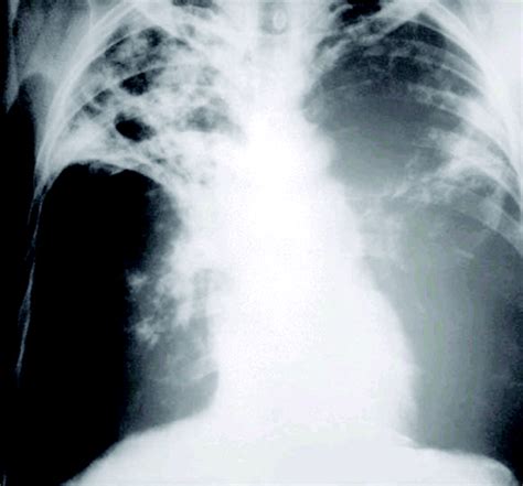 pulmonary tuberculosis chest radiograph   normal