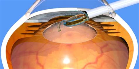 Ask Dr Jimmy Lim Cataracts