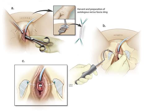 autologous transobturator urethral sling placement for