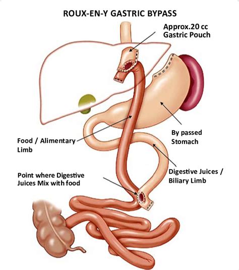 Roux En Y Gastric Bypass Download Scientific Diagram