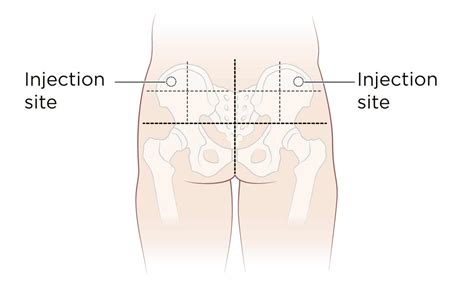 Intramuscular Injection Definition And Patient Education