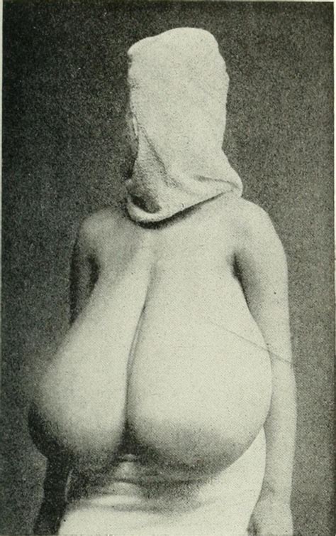 macromastia gigantomastia breast