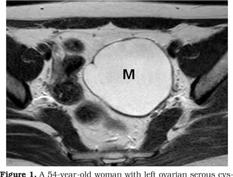 figure   mri features  ovarian cystic lesions semantic scholar