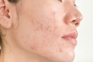 turmeric  acne  ways  heals  skin