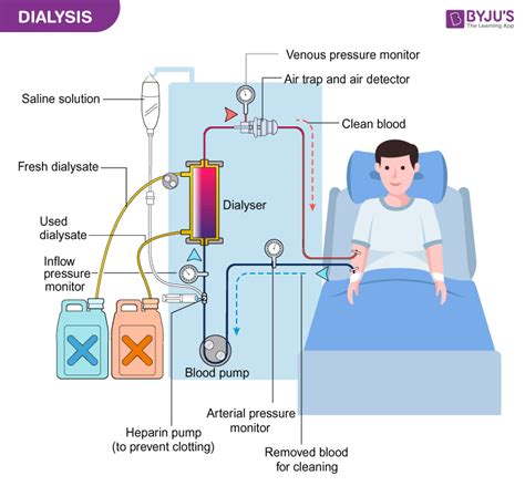 dialysis meaning types principal  advantages  dialysis