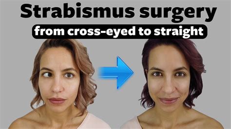strabismus surgery fixing  crossed eyes  vision youtube