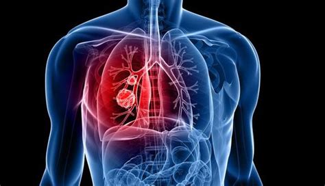 Lung Cancer Definition Causes Symptoms Stages And Tratment