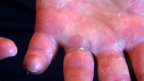 hand foot and mouth disease comes back to tri cities kepr