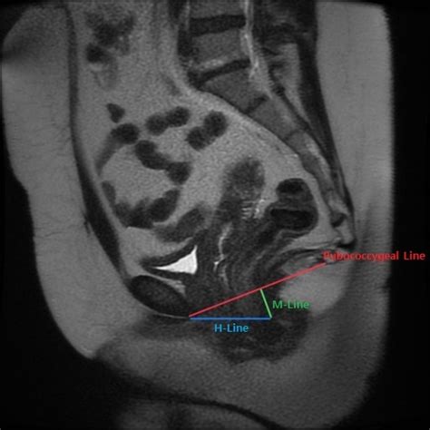 Pelvic Prolapse Imaging Statpearls Ncbi Bookshelf