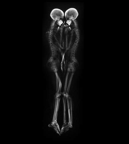 x ray photos of couples