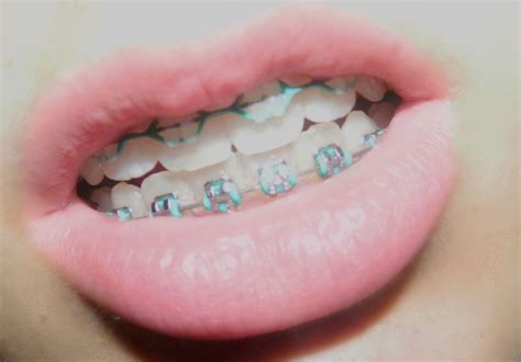 braces lips cute pinterest lips braces colors and dental hygiene