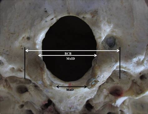 Bicondylar Measurements Bcb Maximum Bicondylar Breadth Mxid