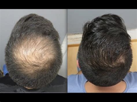 grafts hair transplant  fue technique crown  youtube