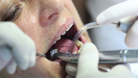 close up of dentist using dental drill on patient s teeth stock footage