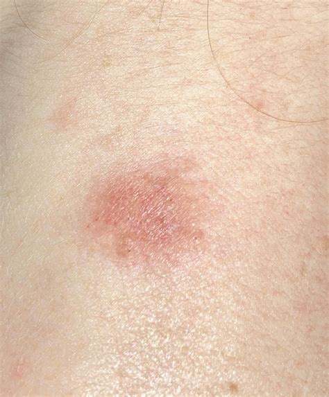 isolated red slightly bumpy patches  skin  itchy