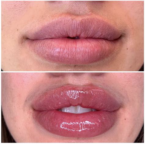 lip injections  applied  give  lips  fuller   average
