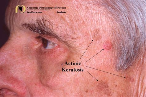 actinic keratosis    academic dermatology  nevada