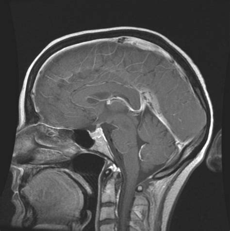 intracranial hypotension wikidoc