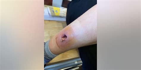 mom claims spider bite left son with gaping hole in leg fox news