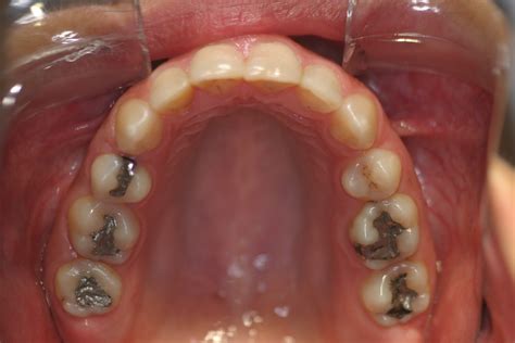extração de quatro pré molares cesar bigarella
