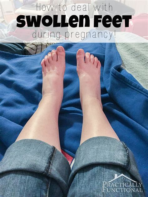Dealing With Swollen Feet During Pregnancy