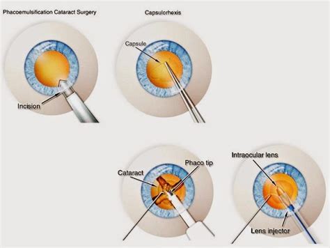 Laser Assisted Cataract Surgery Is It Worth The Cost