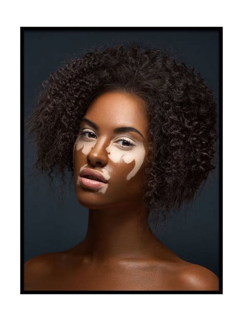 pin  xcom  portraits vitiligo model vitiligo beauty