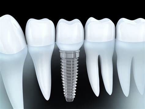 dental implants philp family dentistry waconia dentist