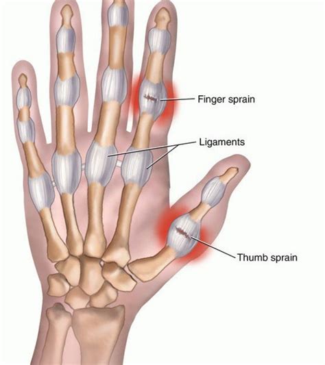 sprained thumb care  treatment orthopaedic surgeons  kenya