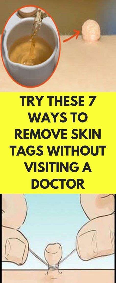 try these 7 ways to remove skin tags without visiting a doctor