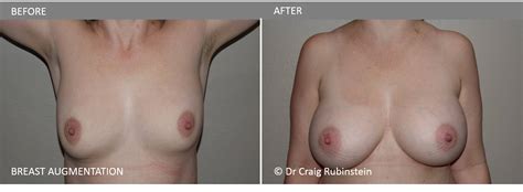 breast augmentation before after mega dildo insertion