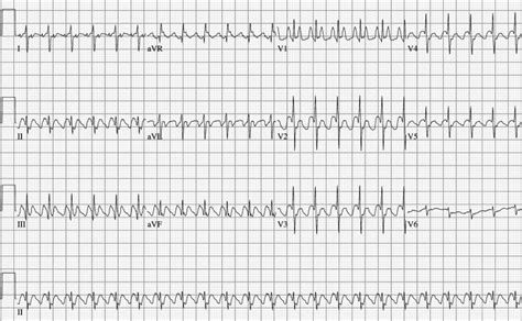 Electrocardiogram Showing Atrial Flutter With Atrioventricular 2 1