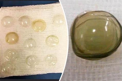 Woman Has 27 Contact Lenses Removed From Eye And She Hadn T Even