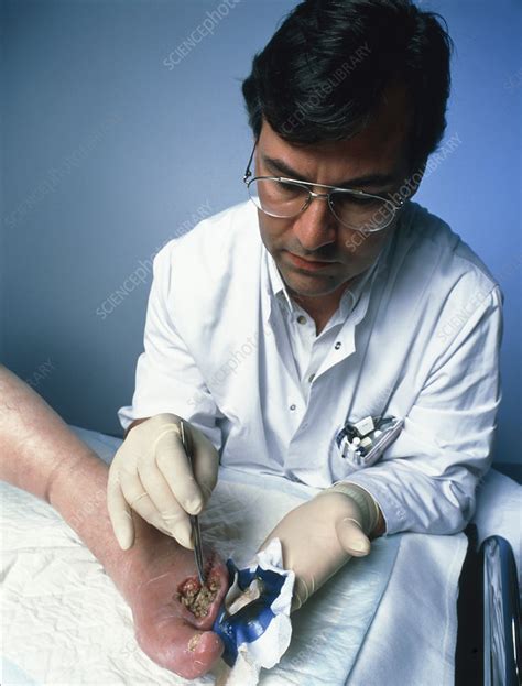 surgeon placing maggots   wound  clean  stock image